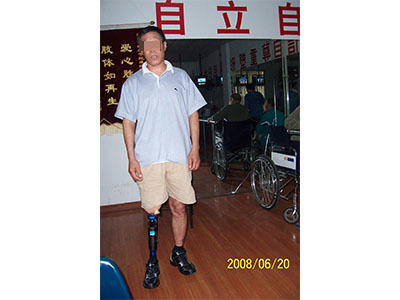 青島市遠(yuǎn)征假肢矯形器 專業(yè)假肢與矯形器的選擇與服務(wù)